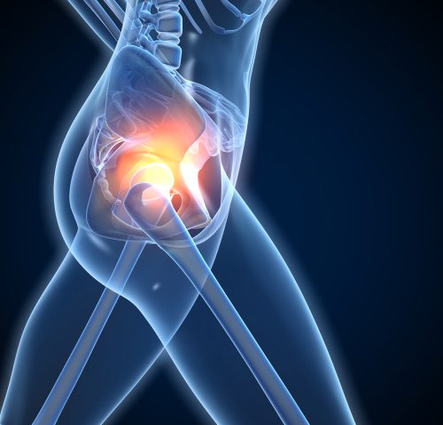 Arthritic Hip Joint And Hip Pain