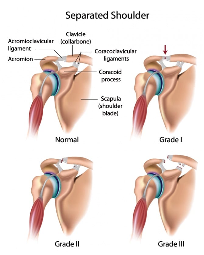 Separated Shoulder Anatomical Diagram