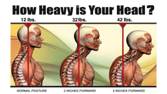 Forward Head  Posture Demonstrates Just How Heavy Your Head Can Be