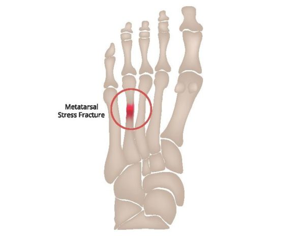 Top View Of Metatarsal Foot Stress Fracture