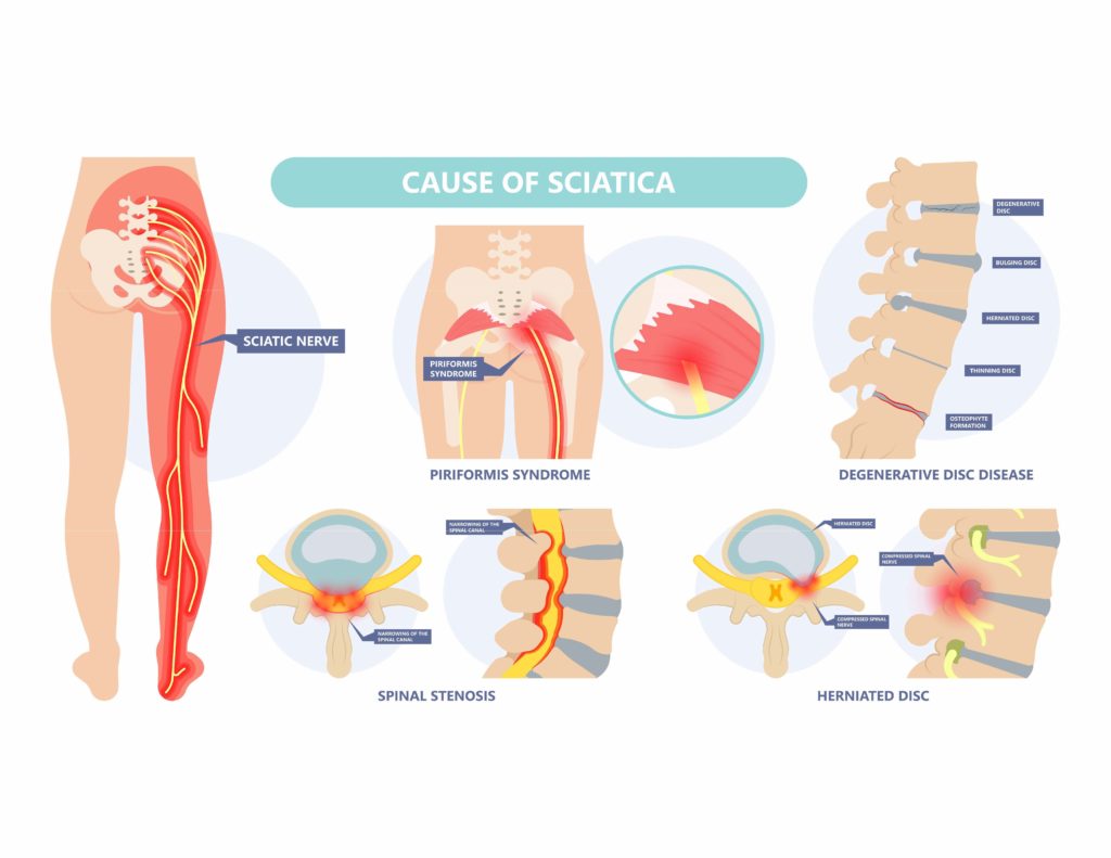 Sciatica Nerve Pain Lower Back Through Hips To Leg