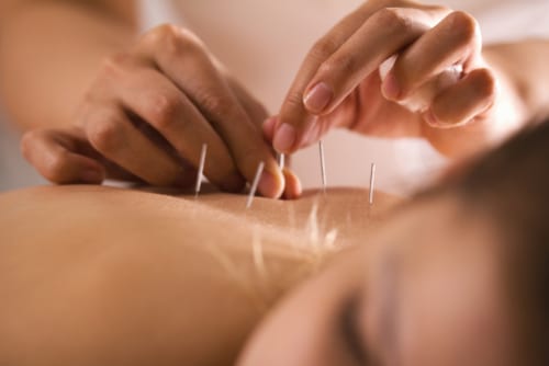 What An Acupuncture Treatment Looks Like