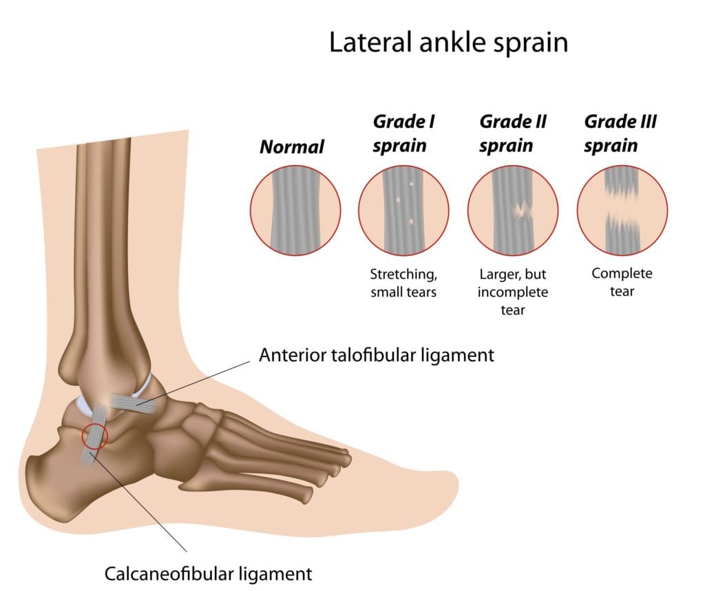 Lateral Ankle Sprain Grades